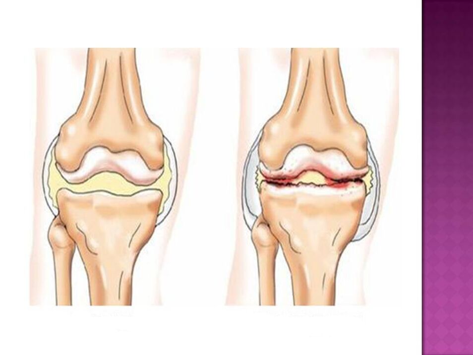 Oynaq normaldır (solda) və osteoartritdən təsirlənir (sağda)