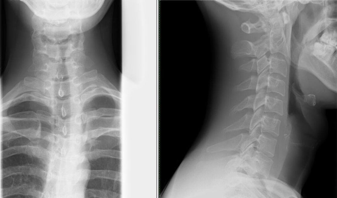 Onurğanın rentgenoqrafiyası osteoxondrozun diaqnozu üçün sadə və təsirli bir üsuldur
