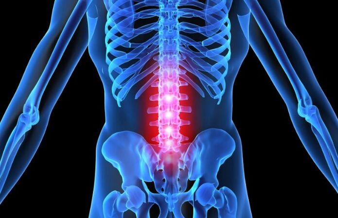 Lomber bölgəsinin osteokondrozu